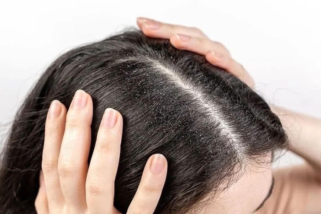 بهترین شامپو ضد شوره زنانه؛ انتخاب بر اساس نوع مو