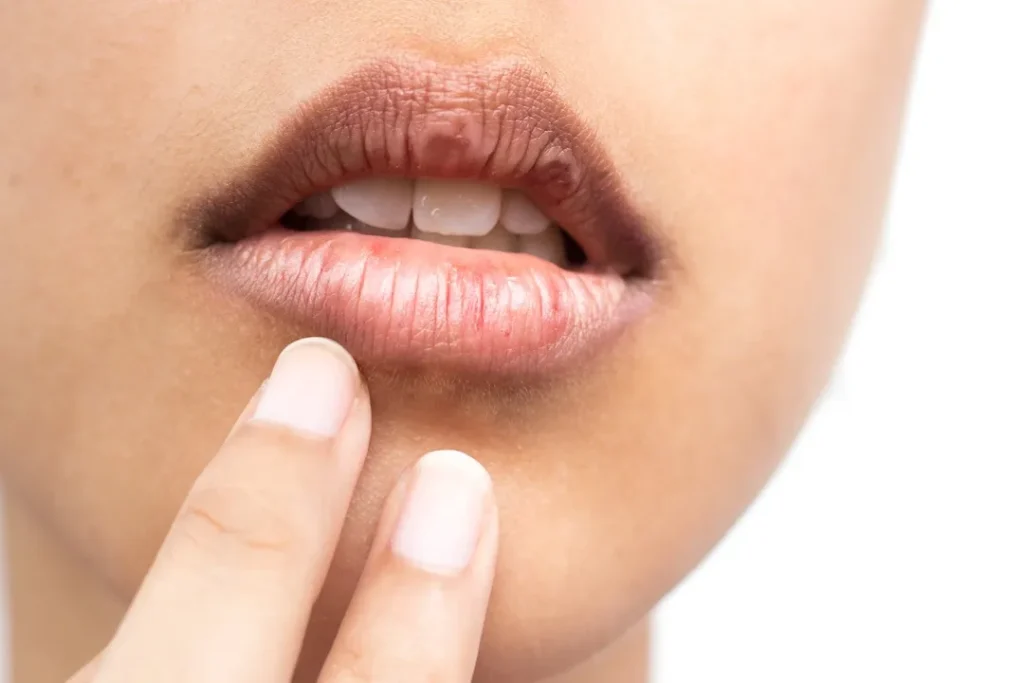 بهترین درمان خشکی لب چیست؟